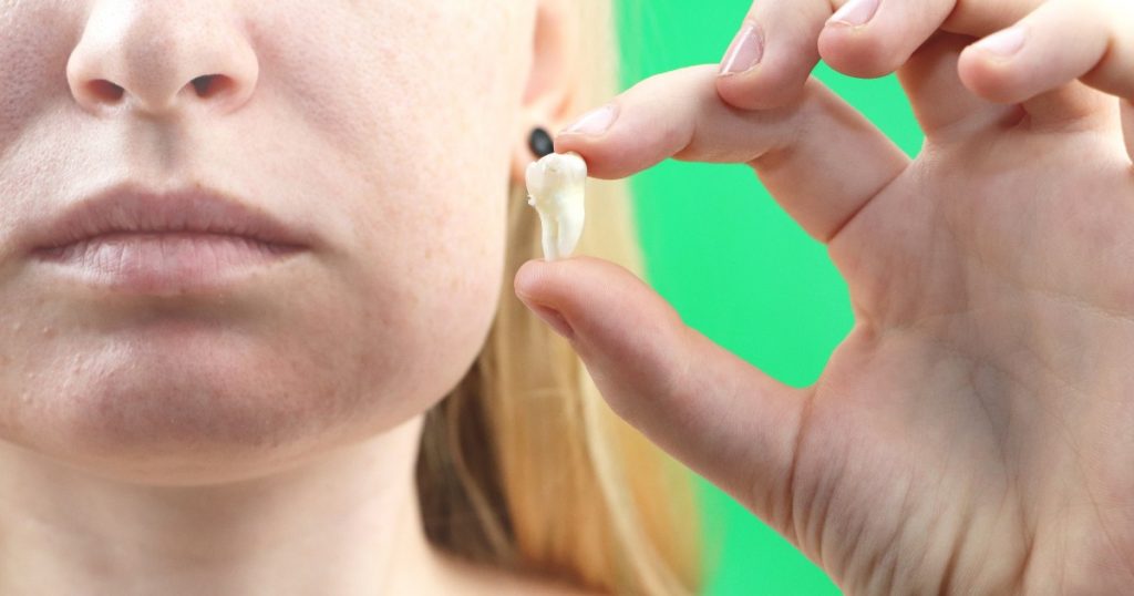 Estrazione di un dente- cosa non fare? Studio Tarallo Dentista Torino